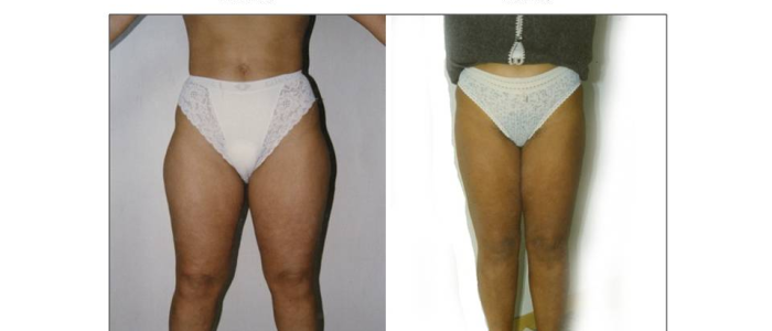 liposcultura2