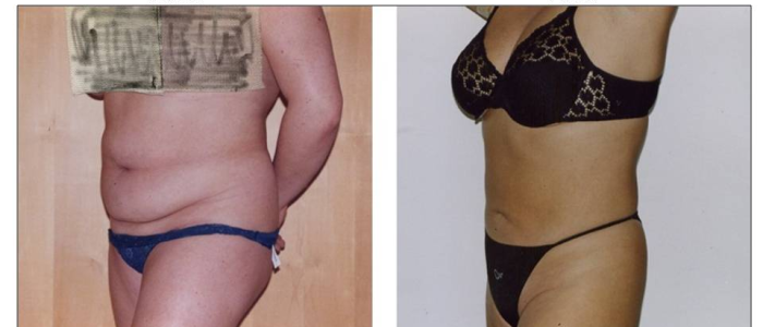 liposcultura3