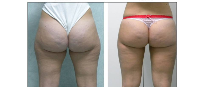 liposcultura4