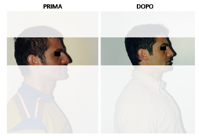 rinoplastica1