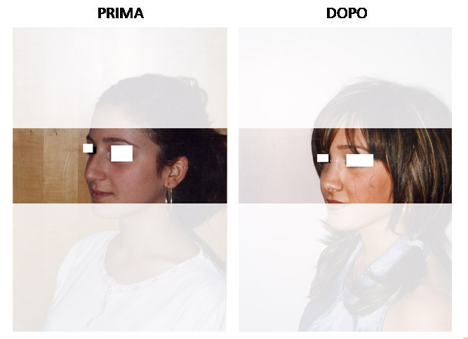rinoplastica4
