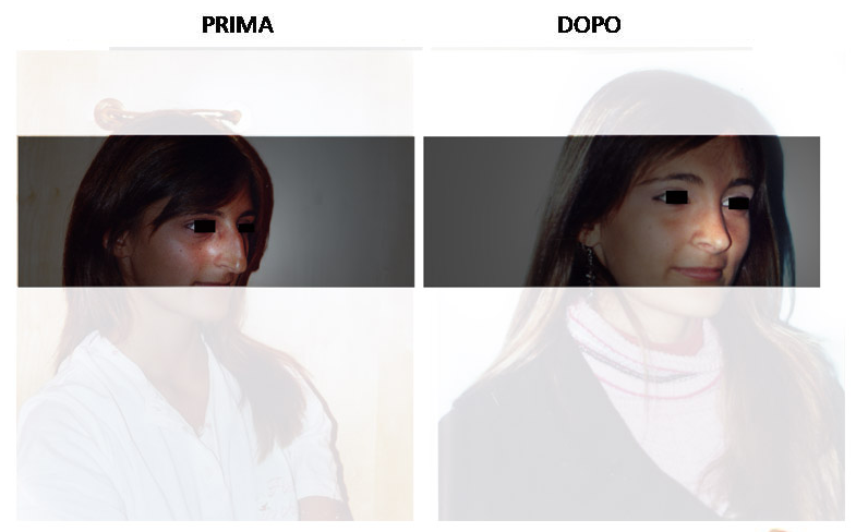 rinoplastica5