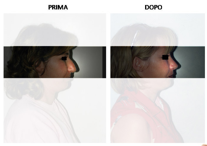rinoplastica6
